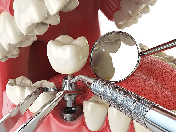 Best Emergency Wisdom Teeth Removal in Orida Ridge, FL
